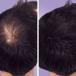 Vorher-nachher-Vergleich: Haarwuchs verbessert sich sichtbar – Vitame Hair Power stärkt Haarstruktur und fördert Fülle.