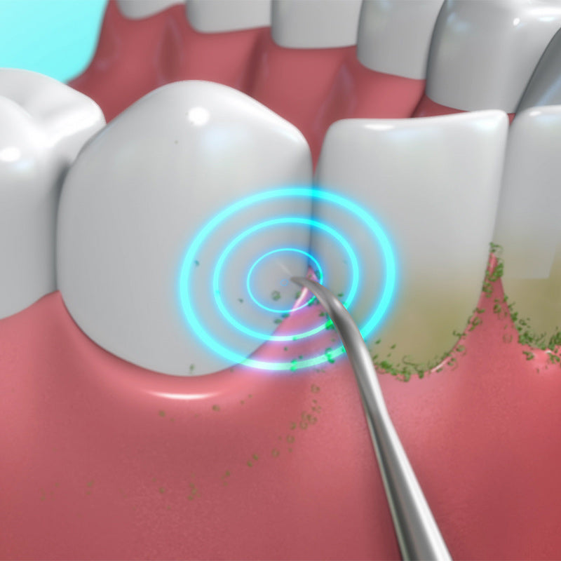 DentaPic Sonic entfernt Plaque präzise mit Schallvibration – gezielte Reinigung bis zum Zahnfleischrand.